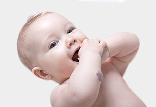 Infantile Hämangiome
