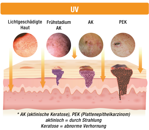 Was ist eine aktinische Keratose? - Pierre Fabre Dermatologie