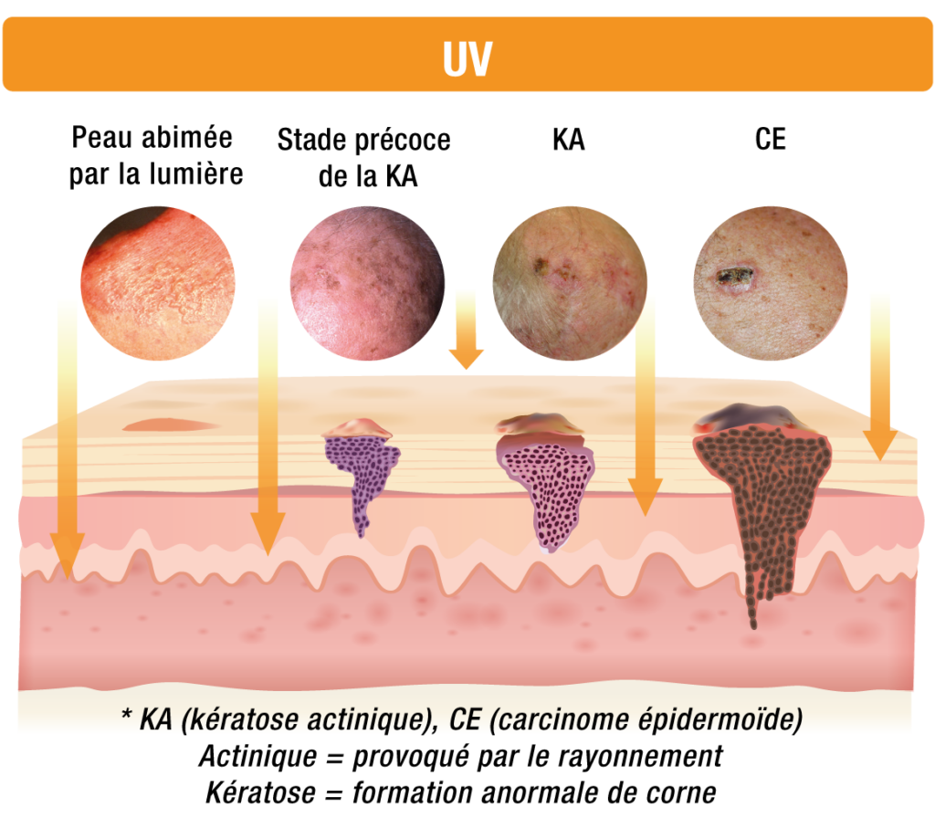 La kératose actinique, qu’estce que c’est? Pierre Fabre Dermatologie — free download