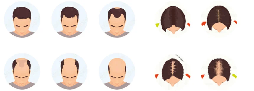 Signes d'une chute de cheveux d'origine héréditaire et hormonale